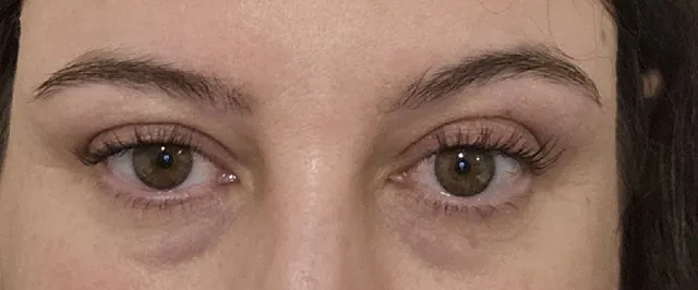 What is best for under eyes from being tired